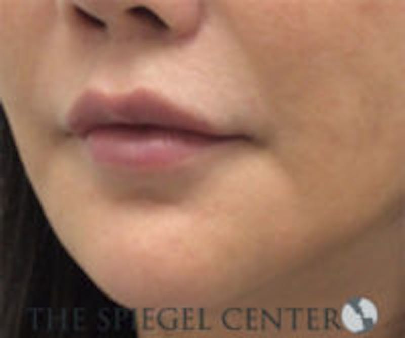 Lip Filler Before & After Gallery - Patient 157563001 - Image 4