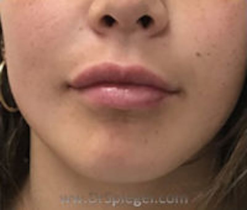 Lip Filler Before & After Gallery - Patient 157563002 - Image 2