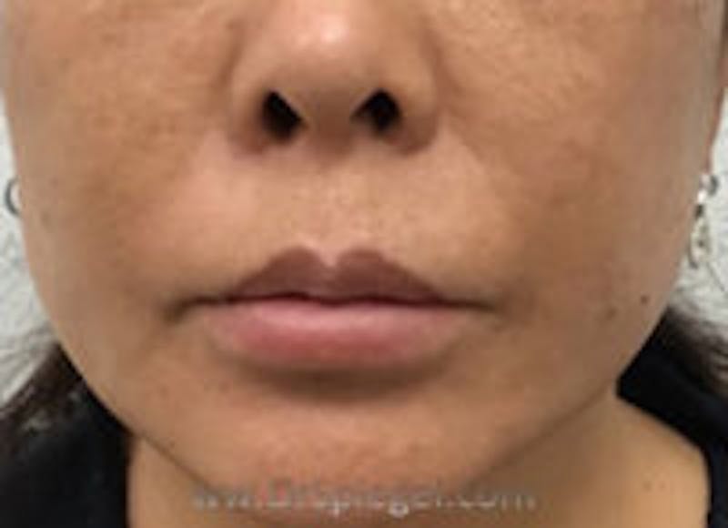 Lip Filler Before & After Gallery - Patient 157563003 - Image 1