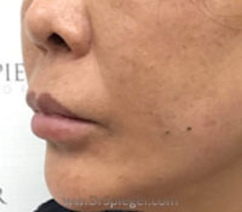 Lip Filler Before & After Gallery - Patient 157563003 - Image 3