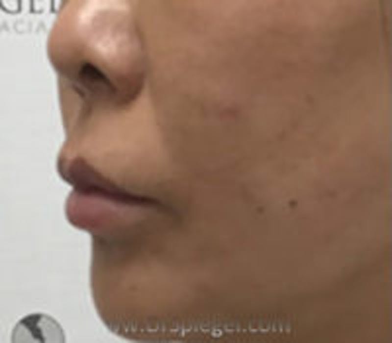 Lip Filler Before & After Gallery - Patient 157563003 - Image 4