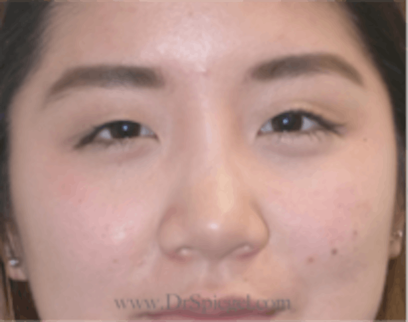 Blepharoplasty Before & After Gallery - Patient 157139807 - Image 1