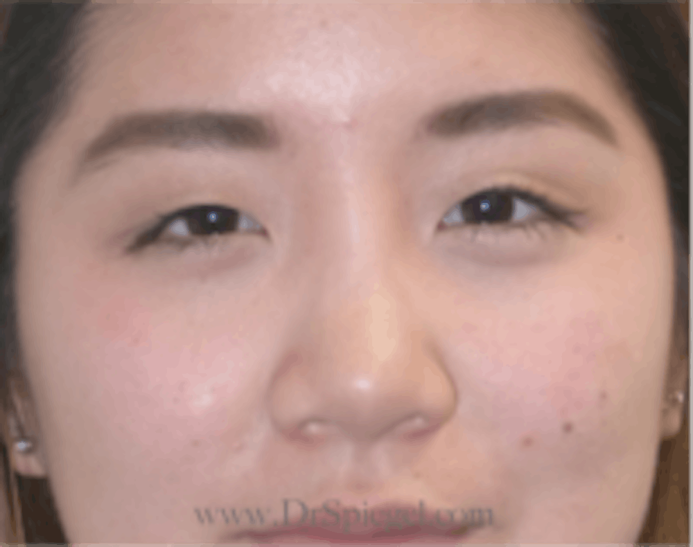 Blepharoplasty