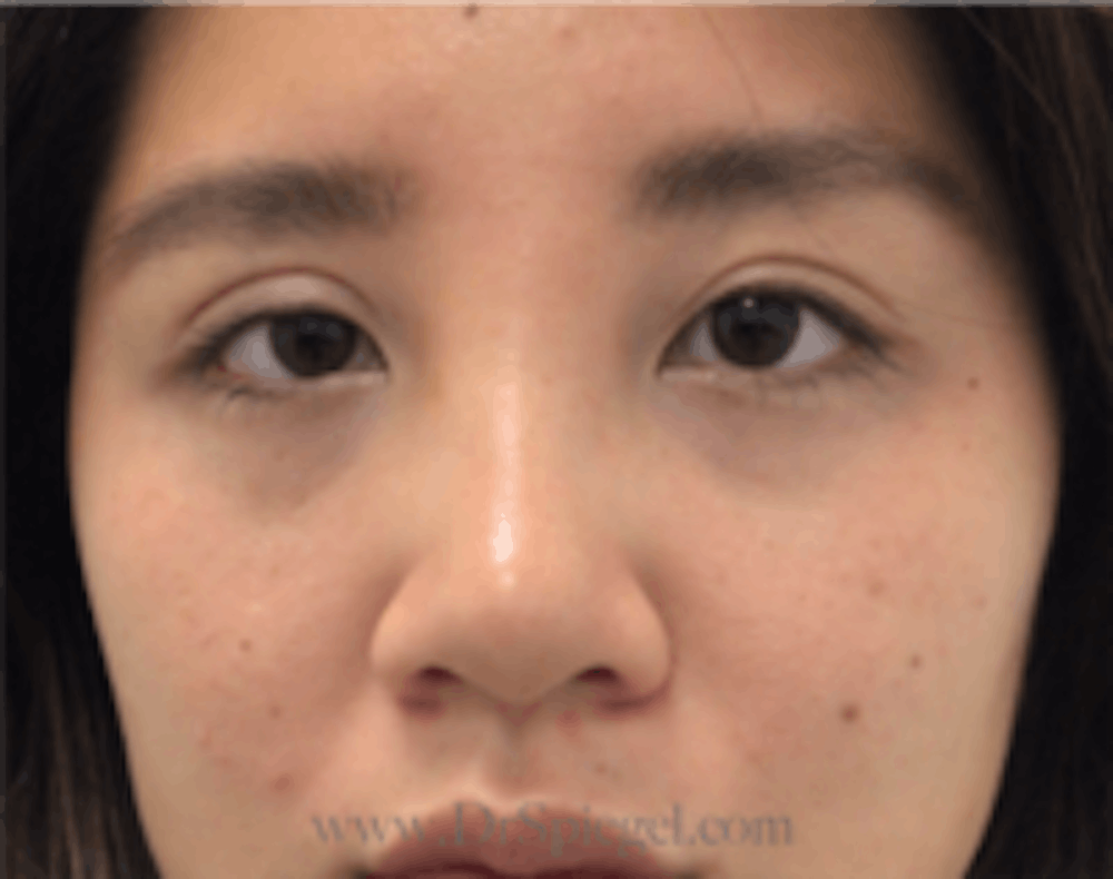 Blepharoplasty
