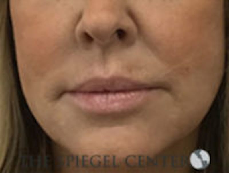Corner Lip Lift Before & After Gallery - Patient 157139811 - Image 1