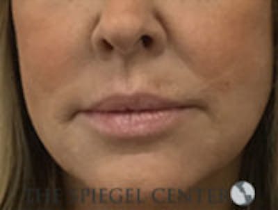 Corner Lip Lift Before & After Gallery - Patient 157139811 - Image 1