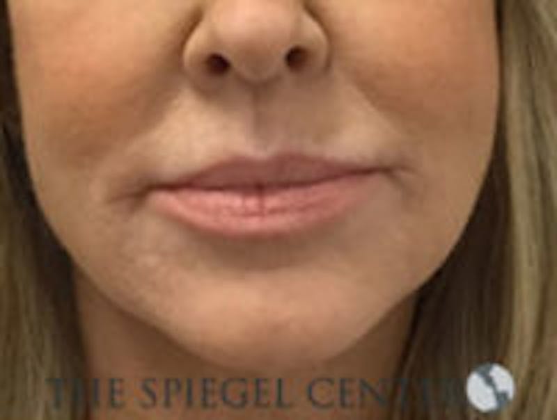 Corner Lip Lift Before & After Gallery - Patient 157139811 - Image 2