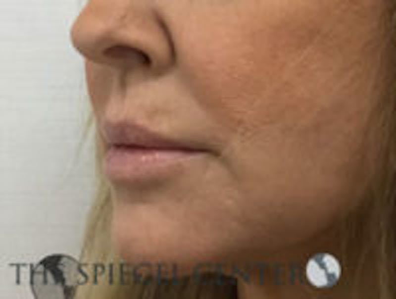 Corner Lip Lift Before & After Gallery - Patient 157139811 - Image 3