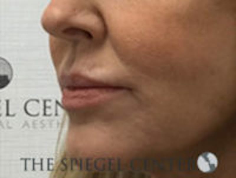 Corner Lip Lift Before & After Gallery - Patient 157139811 - Image 4