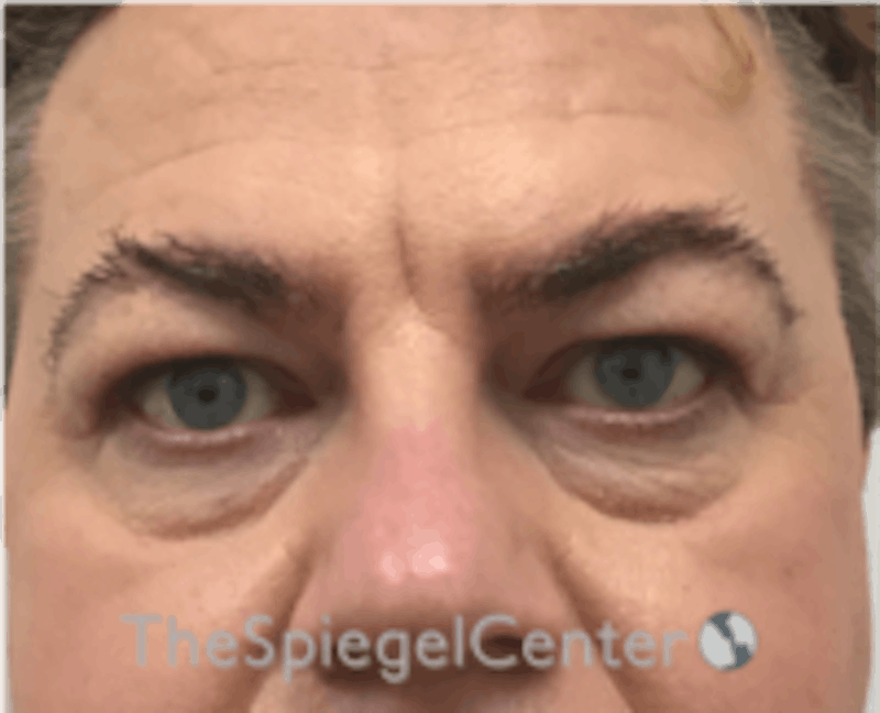 Blepharoplasty Before & After Gallery - Patient 157139817 - Image 1
