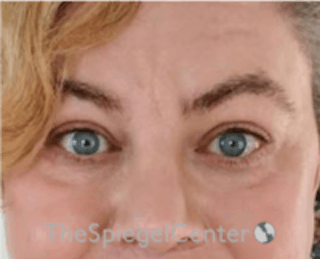 Blepharoplasty Before & After Gallery - Patient 157139817 - Image 2