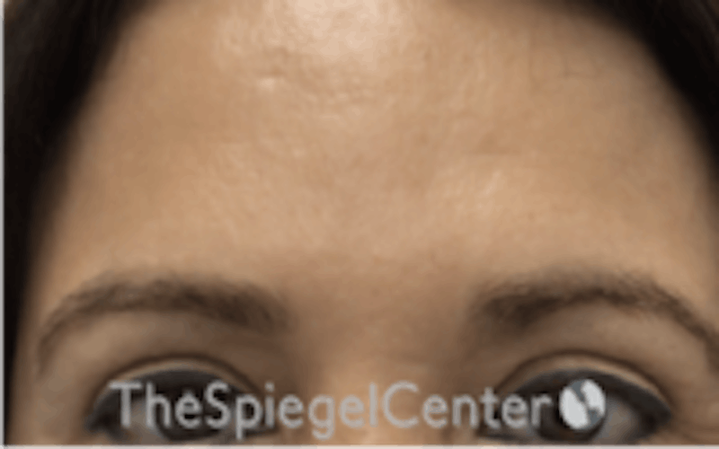 Brow Lift