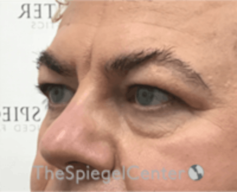 Blepharoplasty Before & After Gallery - Patient 157139817 - Image 3