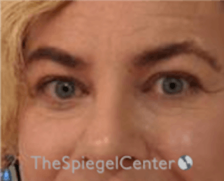 Blepharoplasty Before & After Gallery - Patient 157139817 - Image 4