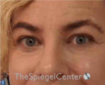 Blepharoplasty Before & After Gallery - Patient 157139817 - Image 4