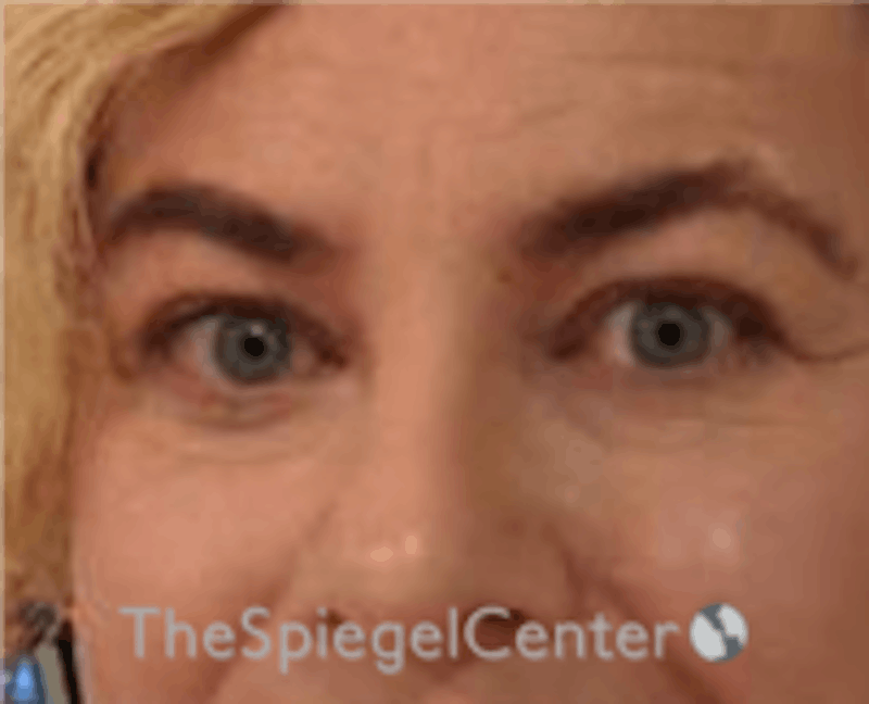 Blepharoplasty Before & After Gallery - Patient 157139817 - Image 4