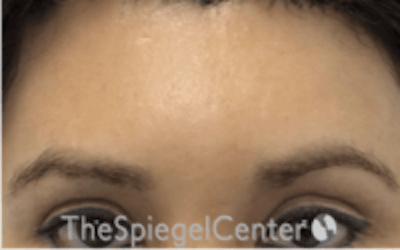 Browlift / Fox Eye Lift Before & After Gallery - Patient 157139818 - Image 2