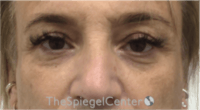 Blepharoplasty Before & After Gallery - Patient 157139820 - Image 1
