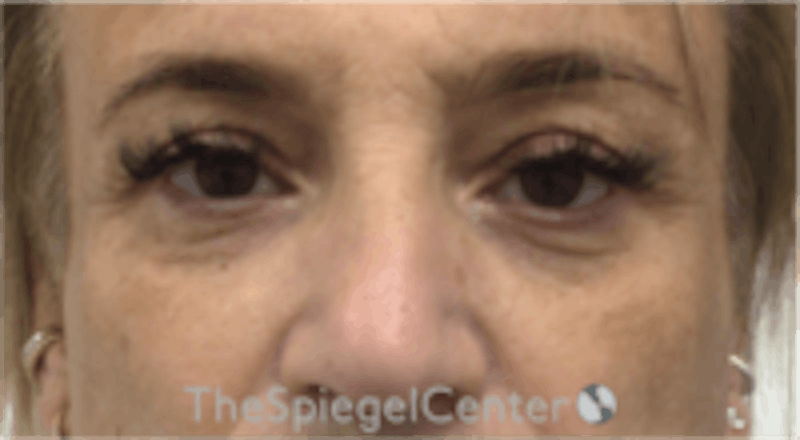 Blepharoplasty Before & After Gallery - Patient 157139820 - Image 1