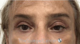 Blepharoplasty Before & After Gallery - Patient 157139820 - Image 2