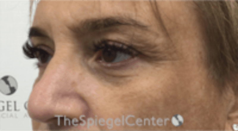 Blepharoplasty Before & After Gallery - Patient 157139820 - Image 3
