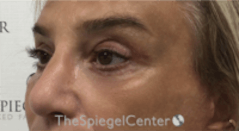 Blepharoplasty Before & After Gallery - Patient 157139820 - Image 4