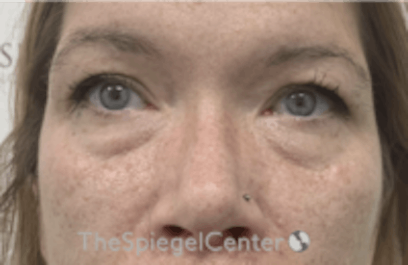 Blepharoplasty Before & After Gallery - Patient 157139824 - Image 1