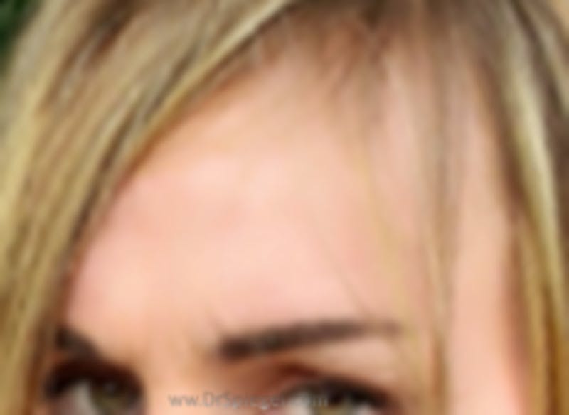 Browlift / Fox Eye Lift Before & After Gallery - Patient 157139823 - Image 1
