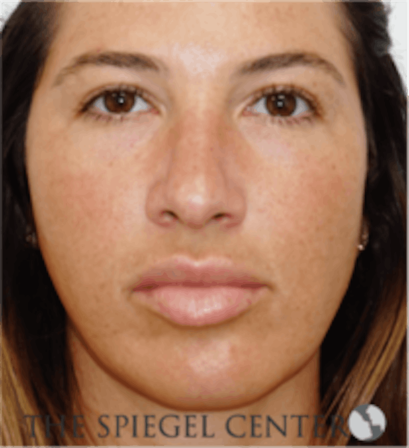 Buccal Fat Reduction Before & After Gallery - Patient 157139826 - Image 1