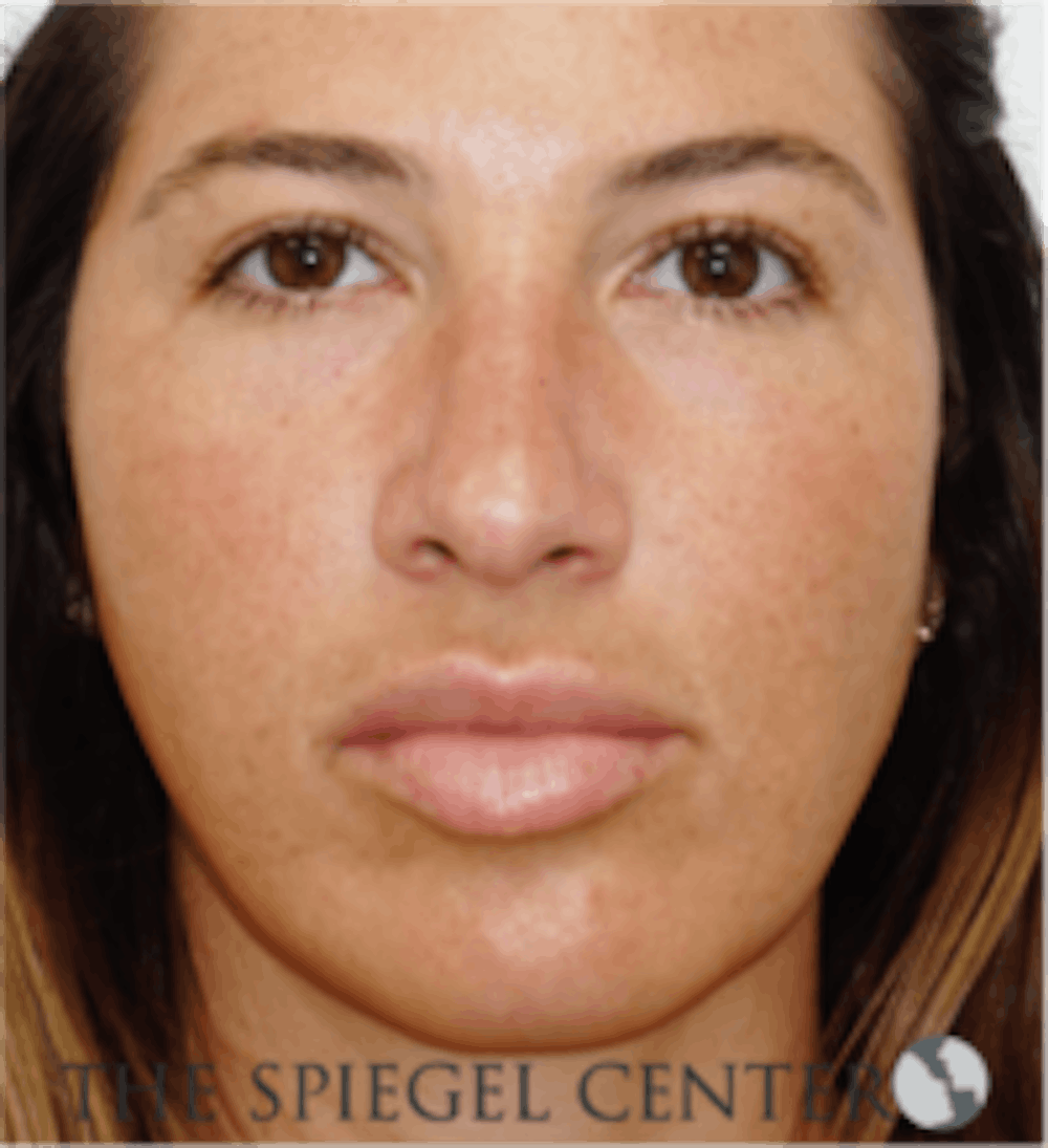 Buccal Fat Removal