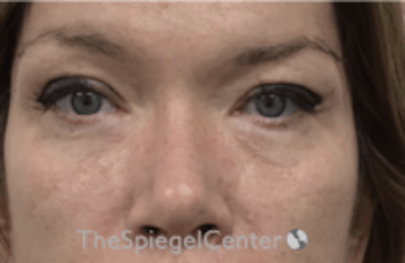 Blepharoplasty Before & After Gallery - Patient 157139824 - Image 2