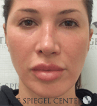 Buccal Fat Reduction Before & After Gallery - Patient 157139826 - Image 2