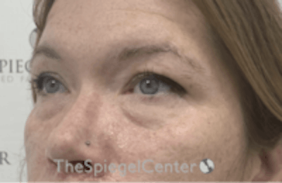 Blepharoplasty Before & After Gallery - Patient 157139824 - Image 3
