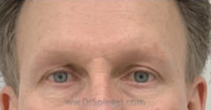 Browlift / Fox Eye Lift Before & After Gallery - Patient 157139825 - Image 1