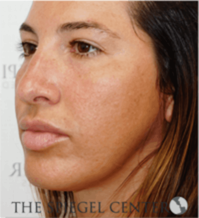 Buccal Fat Reduction Before & After Gallery - Patient 157139826 - Image 3