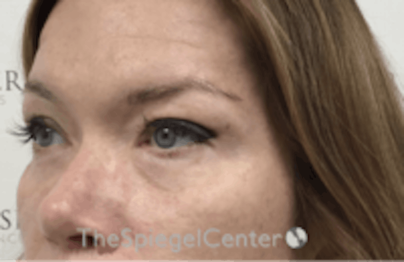Blepharoplasty Before & After Gallery - Patient 157139824 - Image 4