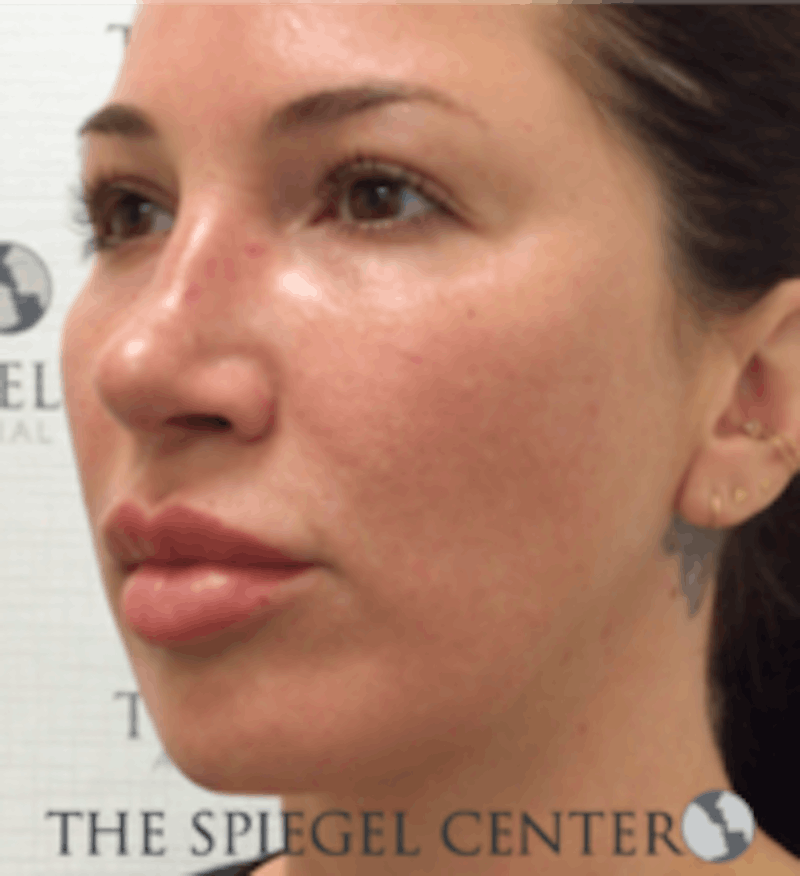 Buccal Fat Reduction Before & After Gallery - Patient 157139826 - Image 4