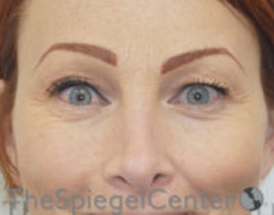 Blepharoplasty Before & After Gallery - Patient 157139829 - Image 1