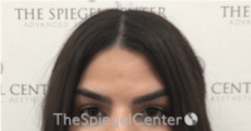 Browlift / Fox Eye Lift Before & After Gallery - Patient 157139828 - Image 1