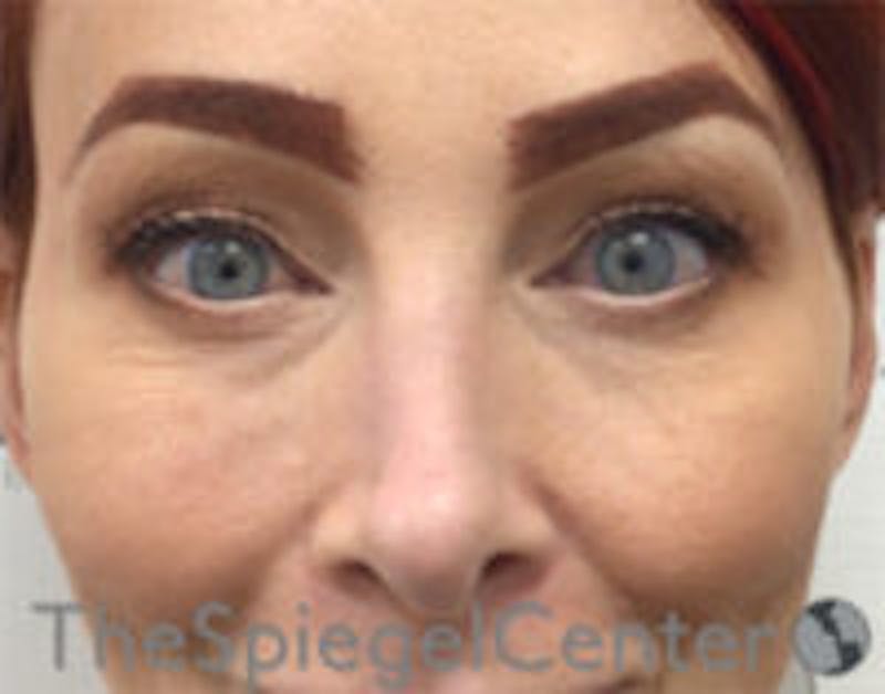 Blepharoplasty Before & After Gallery - Patient 157139829 - Image 2