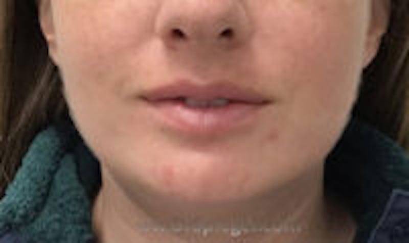 Chin Augmentation Before & After Gallery - Patient 157139832 - Image 2