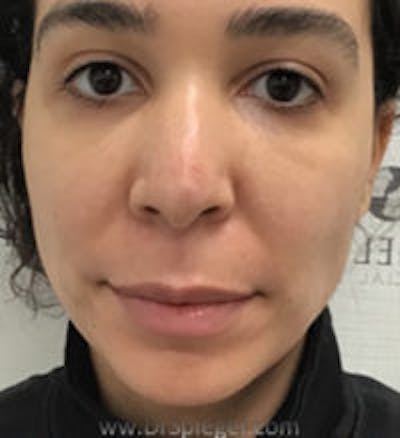 Buccal Fat Reduction Before & After Gallery - Patient 157139830 - Image 2