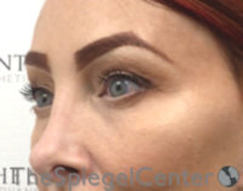 Blepharoplasty Before & After Gallery - Patient 157139829 - Image 4