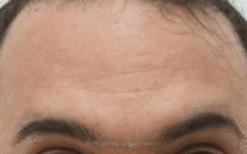 Browlift / Fox Eye Lift Before & After Gallery - Patient 157139831 - Image 1