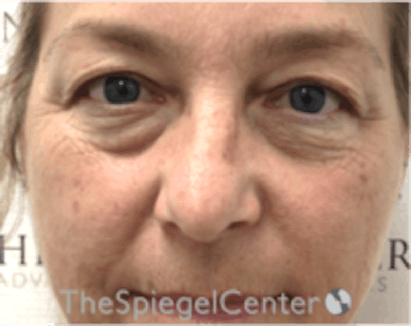 Blepharoplasty Before & After Gallery - Patient 157139834 - Image 1