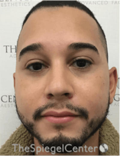 Buccal Fat Reduction Before & After Gallery - Patient 157139838 - Image 1