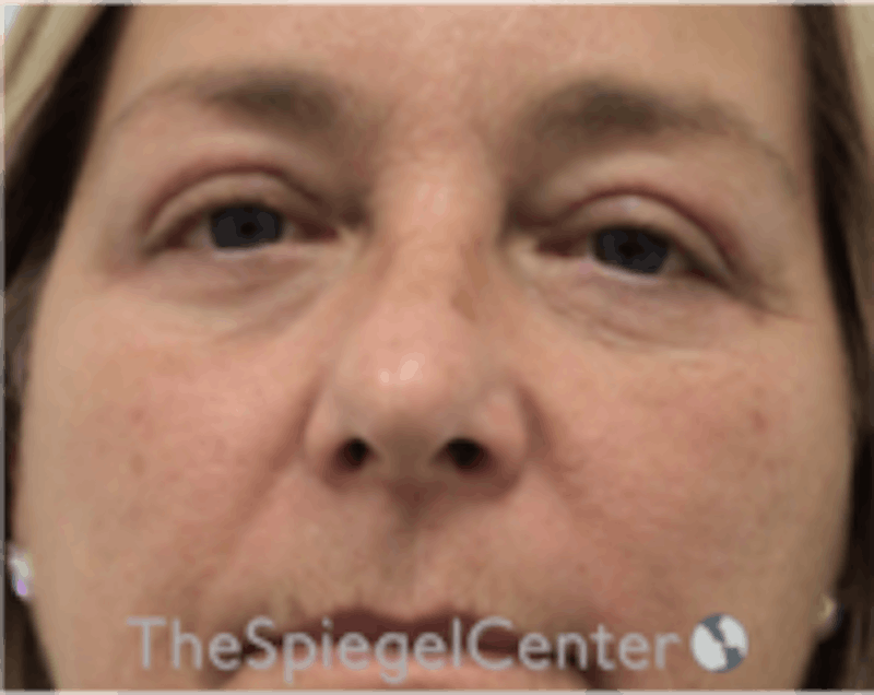 Blepharoplasty Before & After Gallery - Patient 157139834 - Image 2