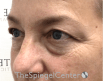 Blepharoplasty Before & After Gallery - Patient 157139834 - Image 3