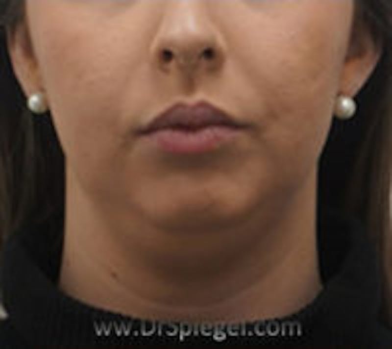 Chin Augmentation Before & After Gallery - Patient 157139839 - Image 1