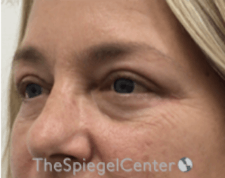 Blepharoplasty Before & After Gallery - Patient 157139834 - Image 4